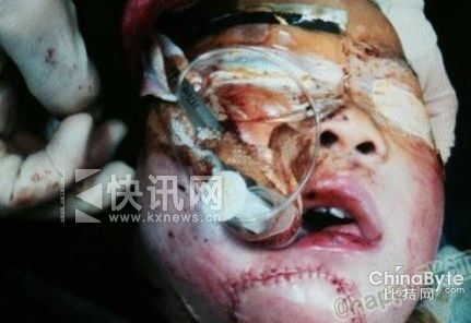 男童遭婶婶割双耳下巴因建房矛盾 6岁凡凡左耳坏死右耳接活