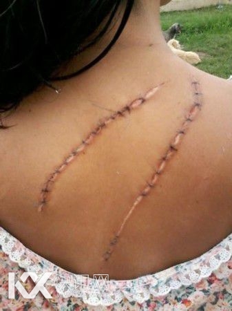 15岁少女因为太美被毁容 这些方法可以祛疤痕(图)