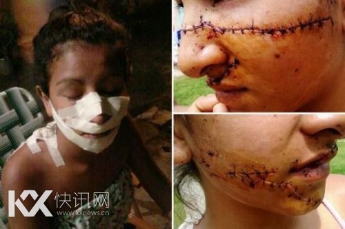 15岁少女因为太美被毁容 这些方法可以祛疤痕(图)