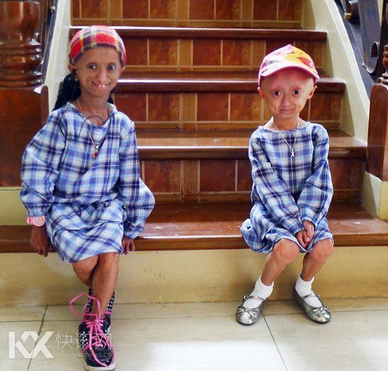 18岁女孩身体年龄达144岁 诊断得早衰症